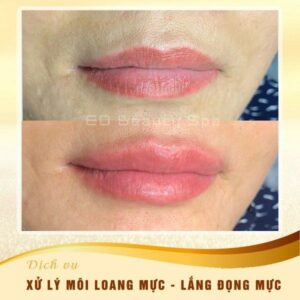 Xử lý môi loang mực, lắng đọng mực