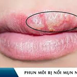 Mụn nước sau phun môi: Nguyên nhân và cách điều trị