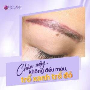 Xăm chân mày lỗi: Nguyên nhân & cách xử lý xăm lông mày bị hỏng