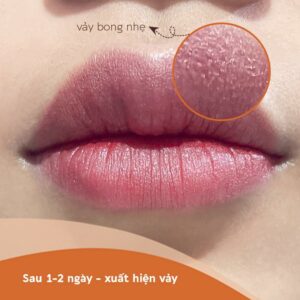 Quá trình bong vảy sau phun môi | Hình ảnh CHI TIẾT