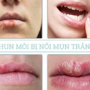 [Lý Do] Phun môi bị nổi mụn trắng: Nguyên nhân, cách xử lý an toàn