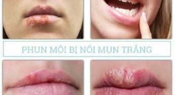 [Lý Do] Tại Sao Phun Môi Gây Mụn Trắng: Nguyên Nhân và Cách Xử Lý An Toàn