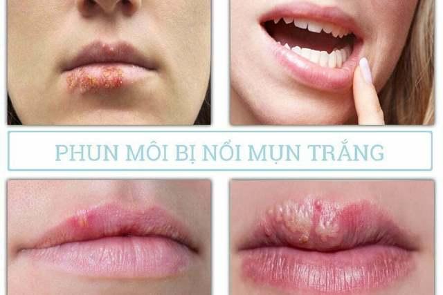 [Lý Do] Phun môi bị nổi mụn trắng: Nguyên nhân, cách xử lý an toàn