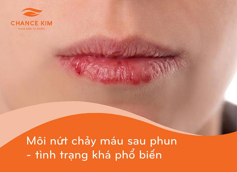 Phun môi xong bị nứt chảy máu có bị làm sao không?